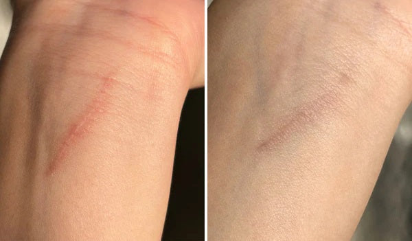 Luviva - Avansert Silikontape for Arrbehandling & Rynker