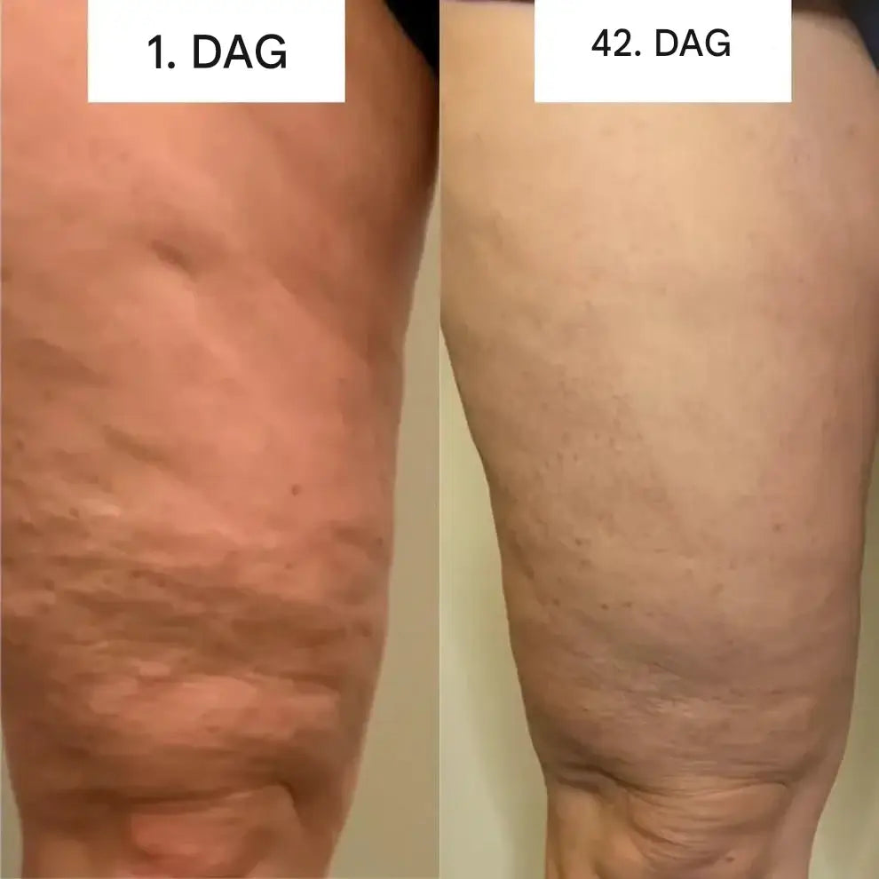 GlowCup – Cellulittfjerner og hudstramming med rødt lys og koppeterapi