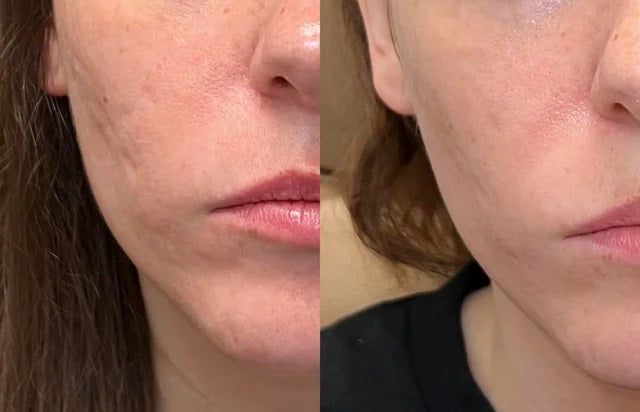 Luviva - Avansert Silikontape for Arrbehandling & Rynker