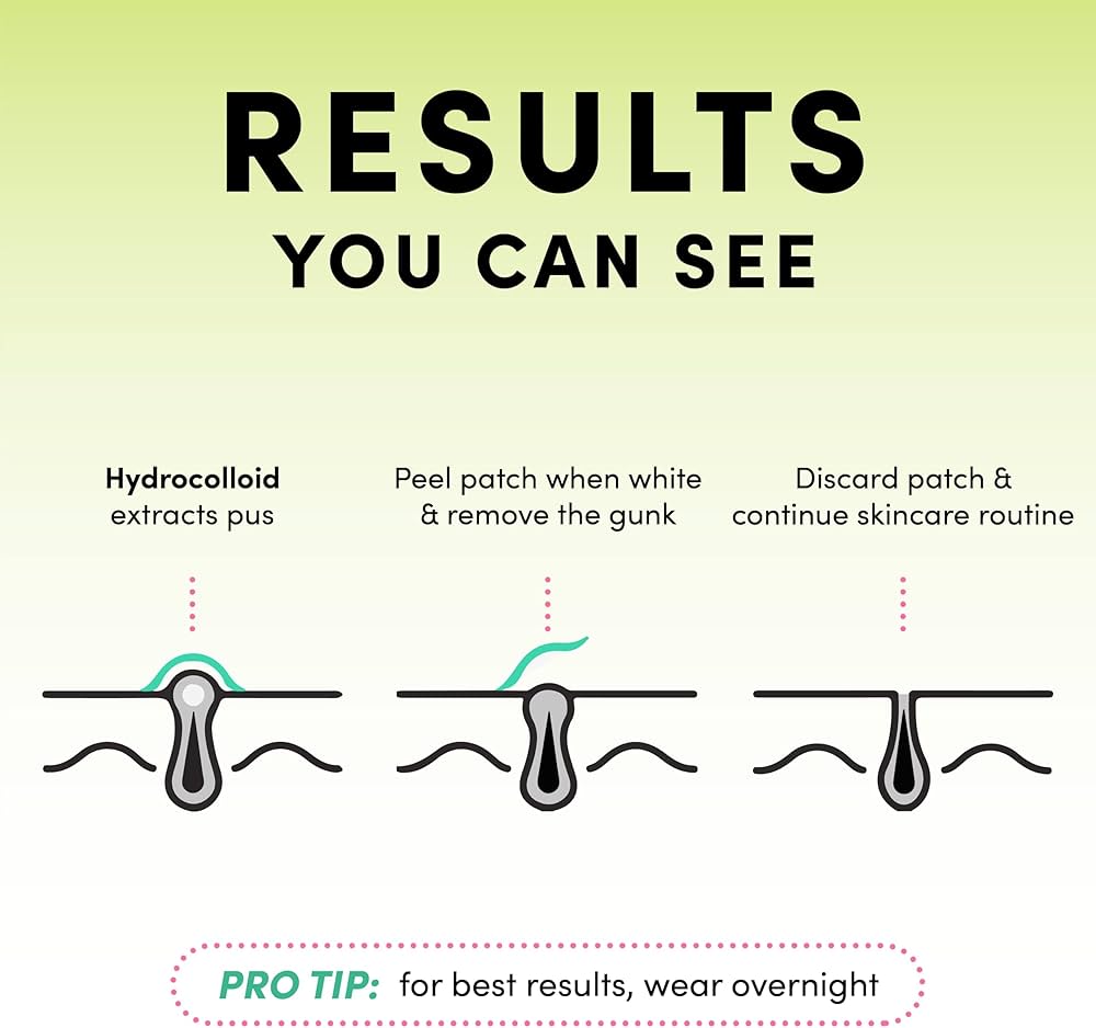 PoreClean - Akneplaster med Hydrokolloid for Frisk Hud på Én Natt