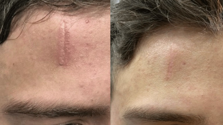 Luviva - Avansert Silikontape for Arrbehandling & Rynker